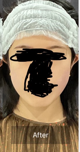 after photo: チタニウムリフト