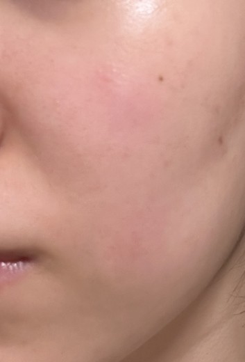 before photo: IPL(光/フォト治療)