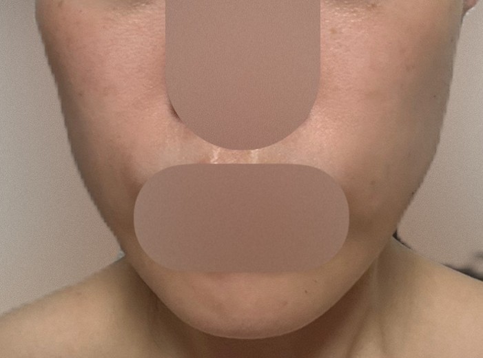 after photo: 脂肪溶解注射(顔)