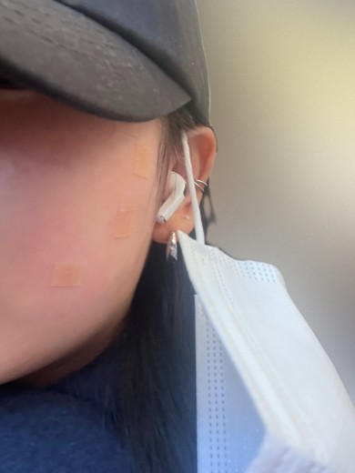 after photo: 점제거시술, 사마귀제거