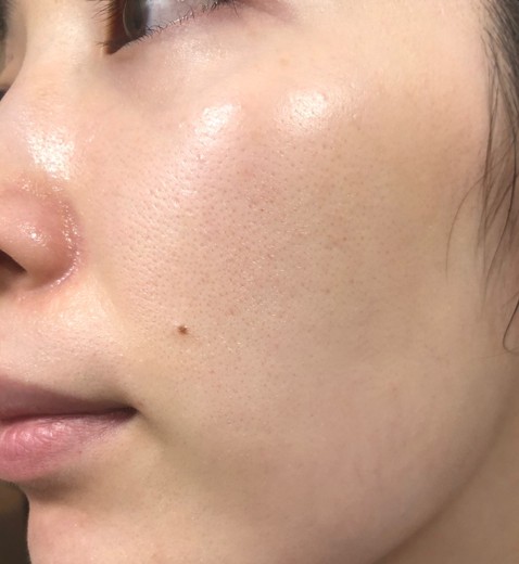 after photo: エレクトロポレーション