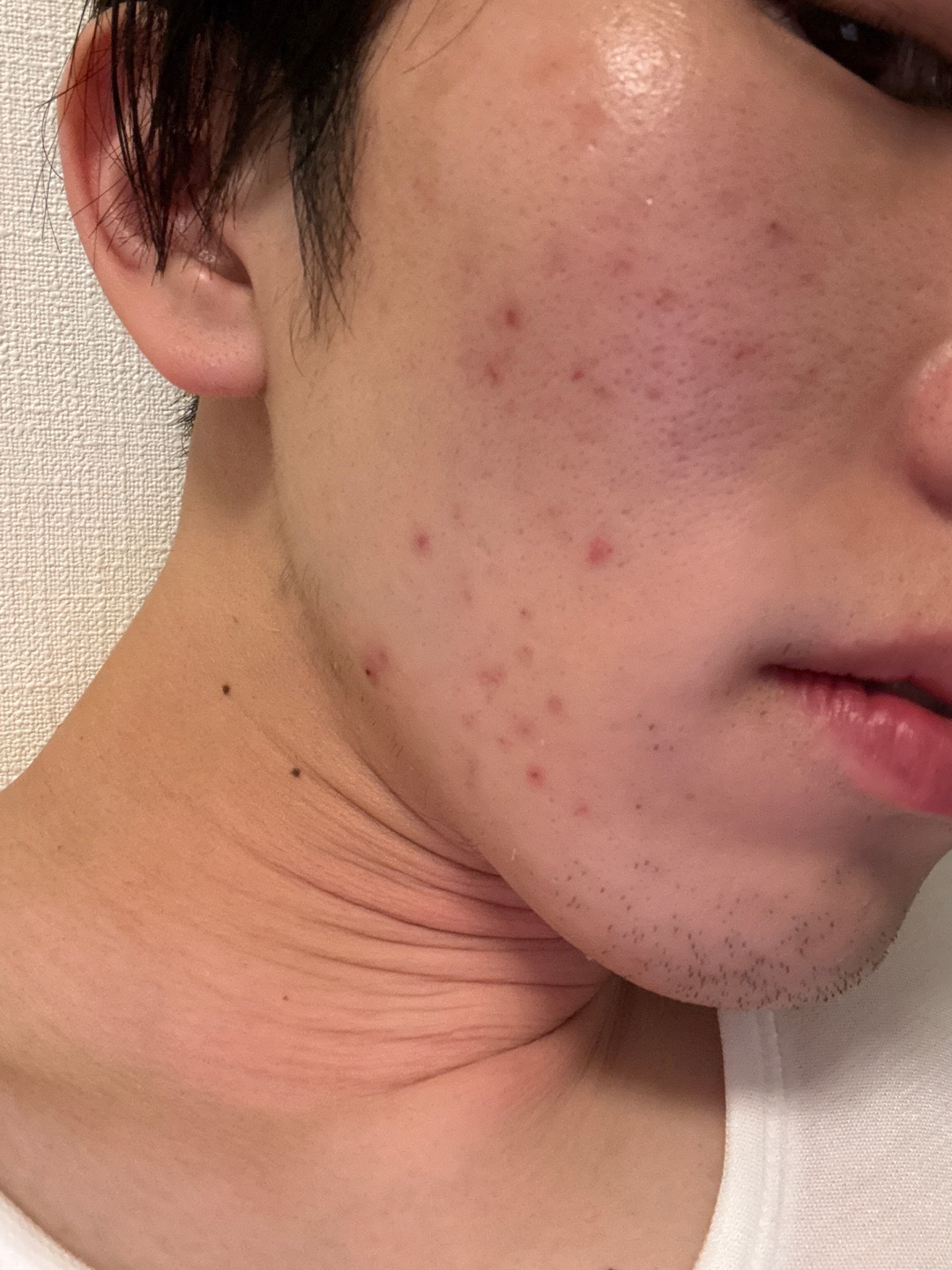 IPL（光治療）全顔2周 ｜ステラM22フォトフェイシャル【1月15日迄にご