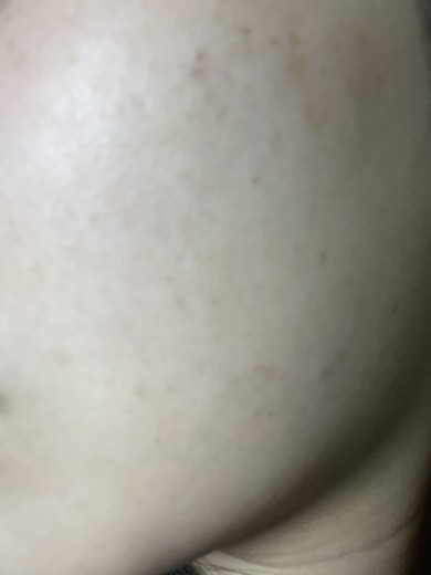 before photo: 白玉注射・点滴