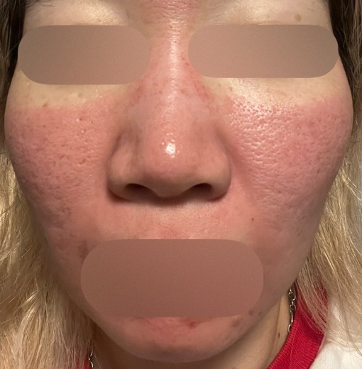 after photo: ダーマペン