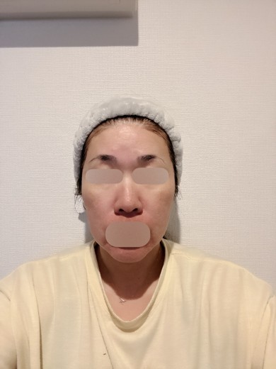 after photo: ヴェルベットスキン