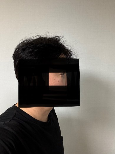 after photo: 눈밑지방재배치