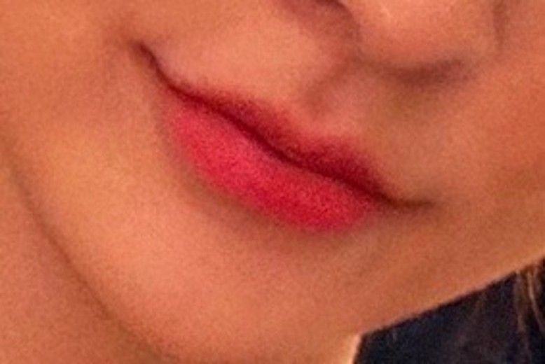 before photo: 입술필러