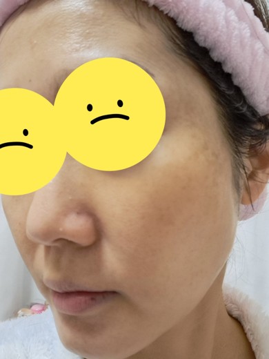 before photo: ピーリング, エレクトロポレーション, ルメッカ