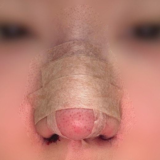 after photo: 콧볼축소, 복코교정(수술)