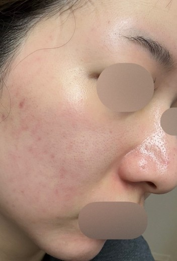 before photo: ダーマペン