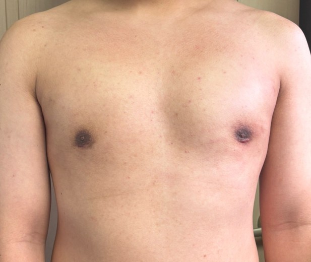 after photo: 여유증수술