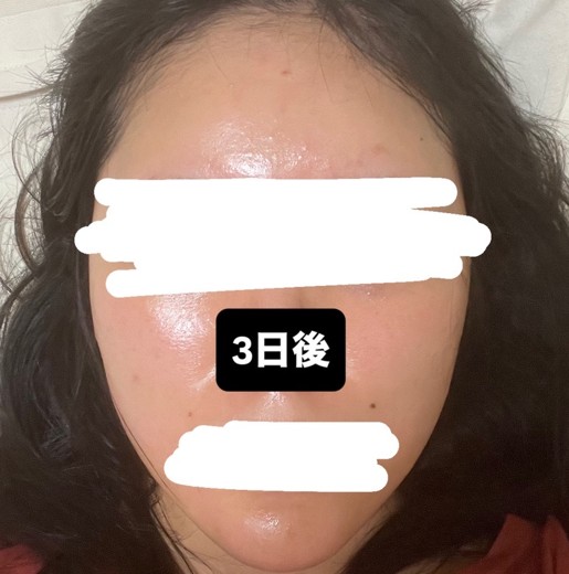 after photo: ピーリング, ルメッカ