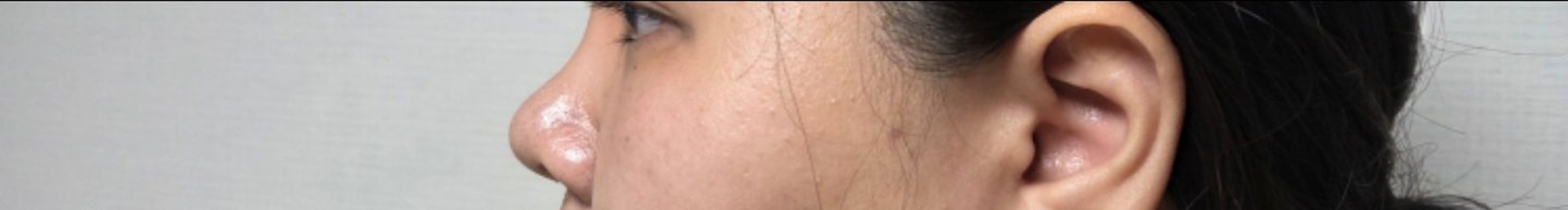 after photo: 비중격만곡증수술, 코끝(보형물)