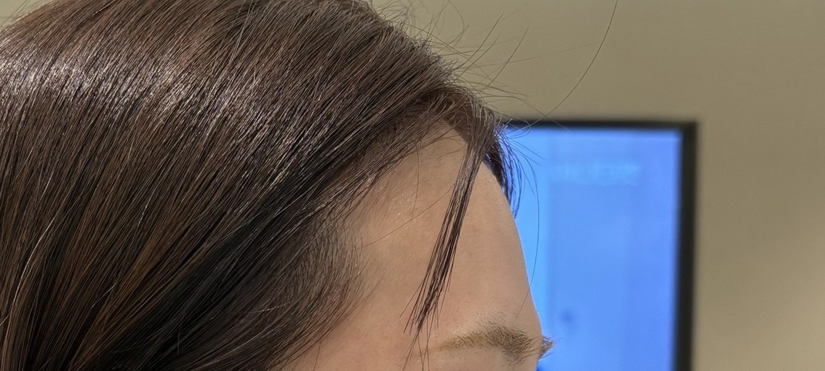 before photo: 이마필러