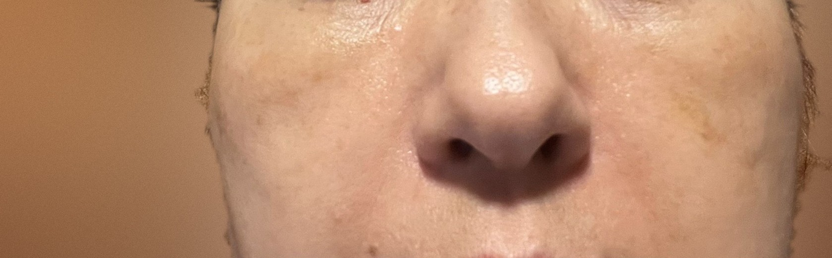 after photo: 脂肪溶解注射(顔)