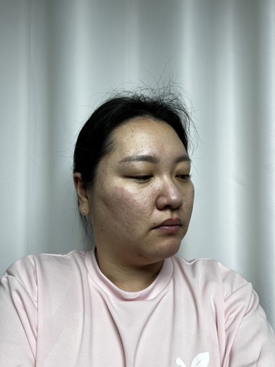 before photo: 점제거시술, V레이저