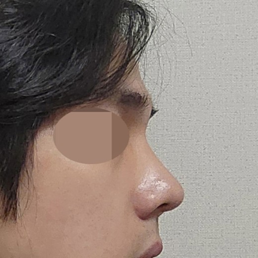 after photo: 코끝(자가연골)