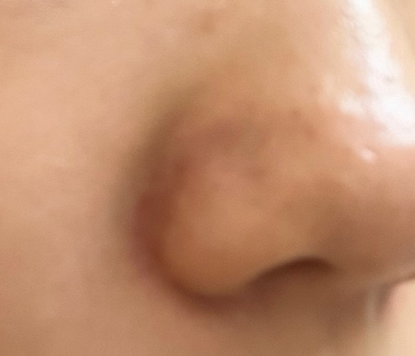 before photo: ハイドラジェントル