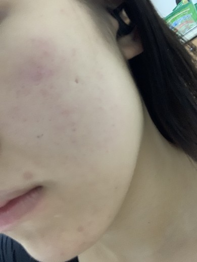 before photo: 脱毛(顔)