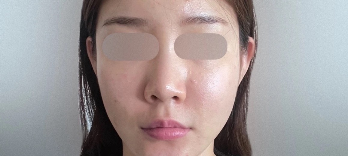 after photo: PRP피부재생술