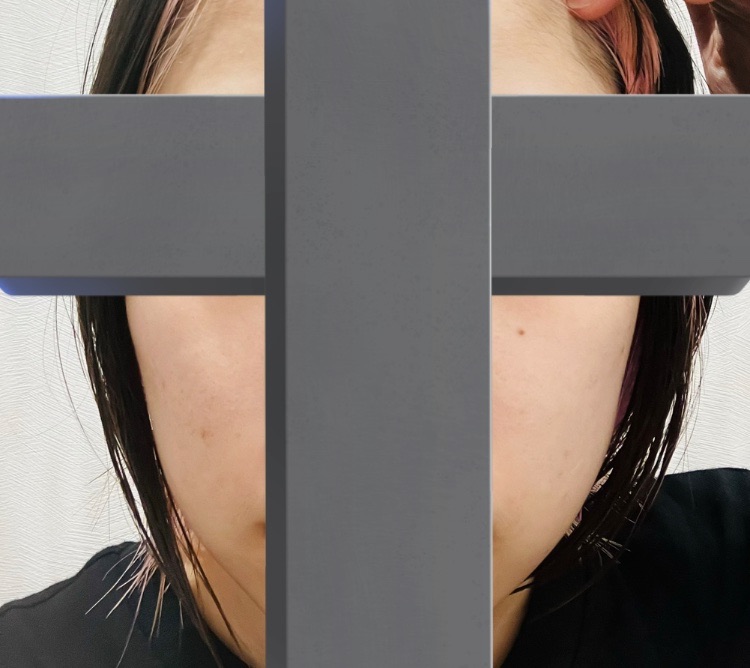 イタリア製 ♧ 口顎首のEx-voto ポテンツァ ダイヤモンドチップ（全顔300ショット）たるみ・引き締めに