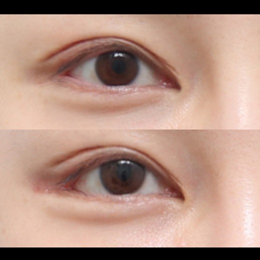 after photo: 밑트임, 뒤트임