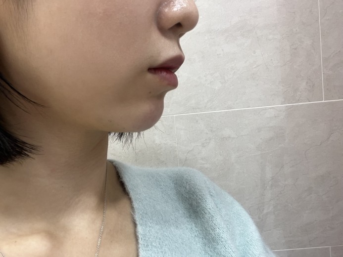 after photo: 턱끝필러