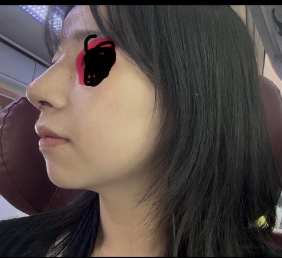 after photo: 비중격만곡증수술