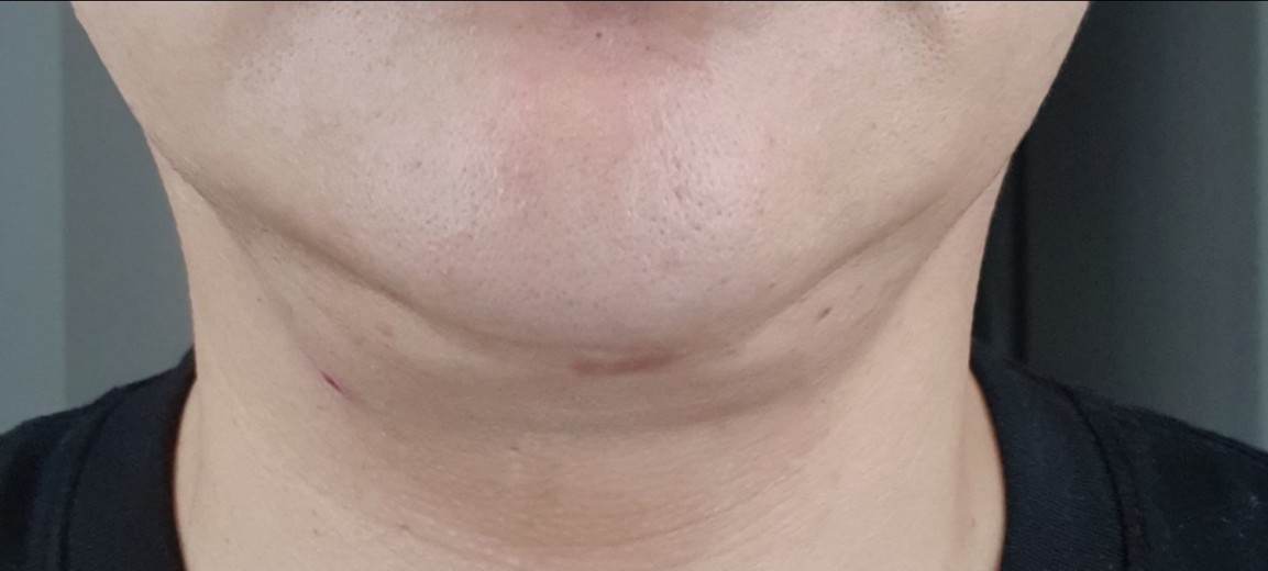 after photo: 이중턱지방흡입, 이중턱근육묶기