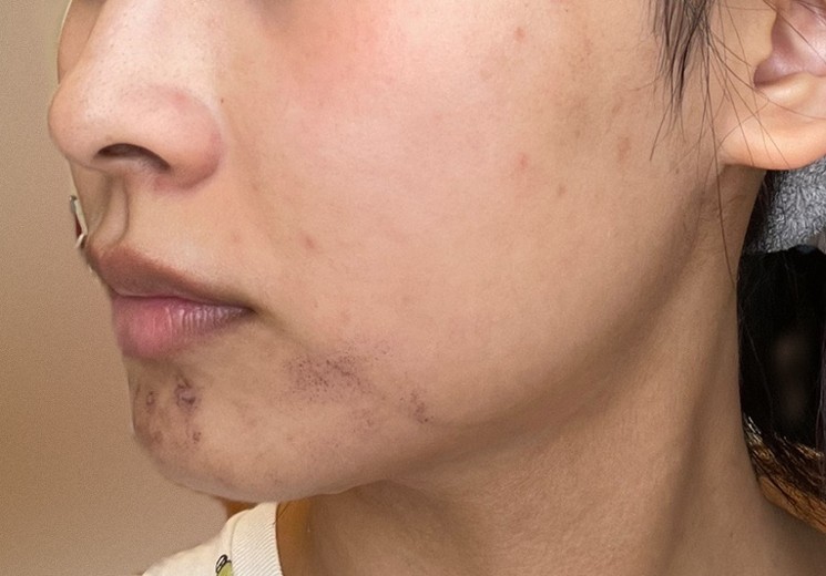 after photo: IPL(光/フォト治療), ルメッカ