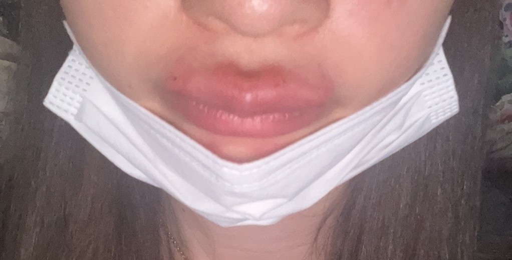 after photo: 口角ボトックス, 唇ヒアルロン酸