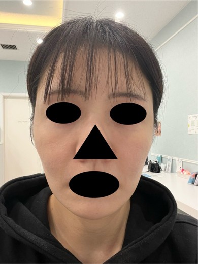 before photo: ボルニューマ
