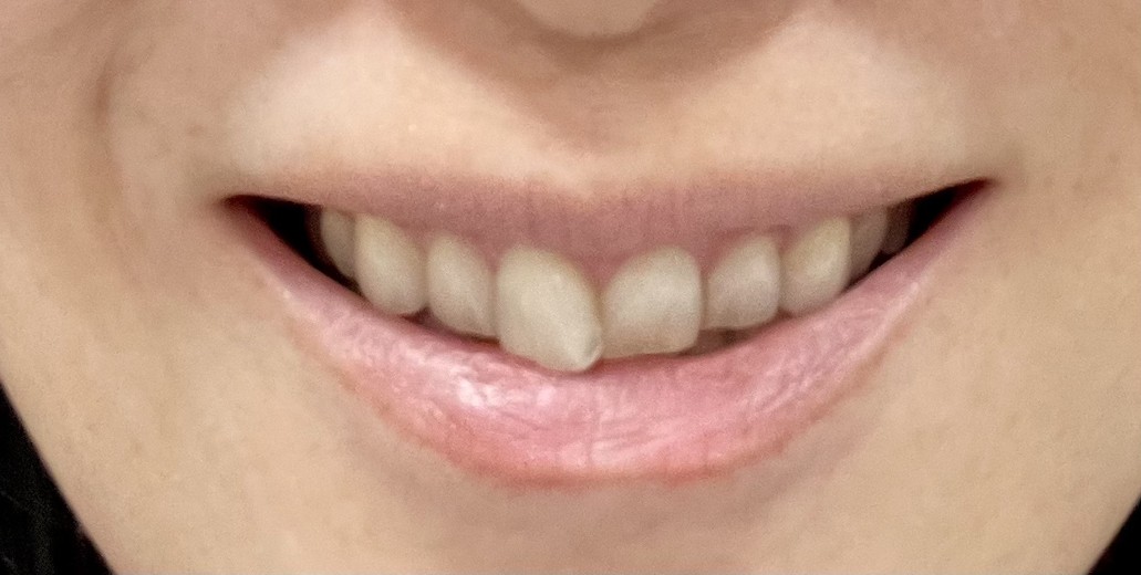 before photo: ホワイトニング