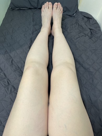 after photo: 脂肪溶解注射(太もも)