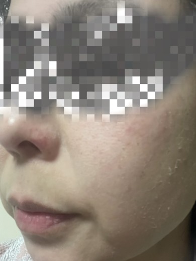 after photo: ピーリング, ルメッカ