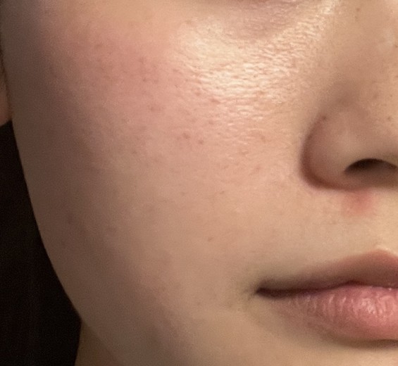 after photo: IPL(光/フォト治療), ルメッカ