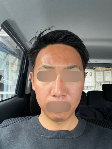 after photo: ダーマペン