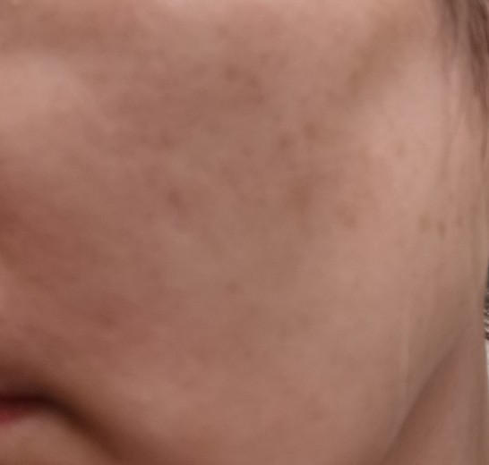 before photo: IPL(光/フォト治療)