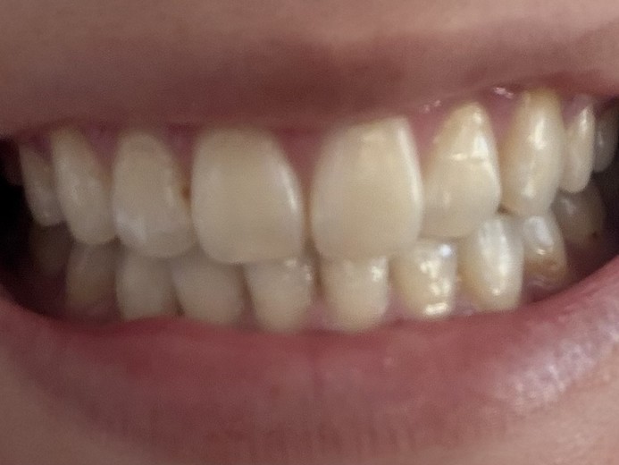 after photo: ホワイトニング