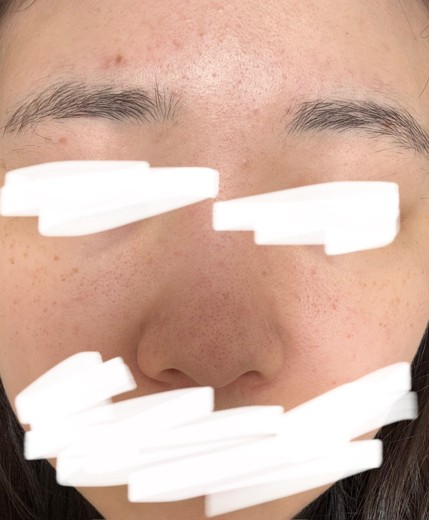 before photo: ハイドラフェイシャル