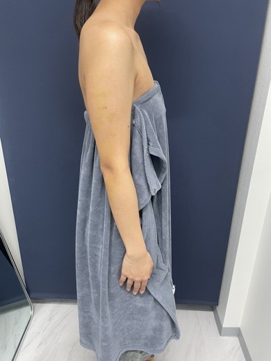 after photo: 脂肪吸引(腕)