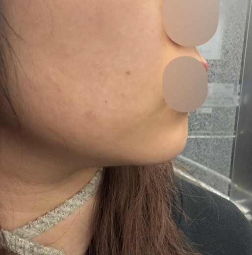 before photo: 턱끝필러