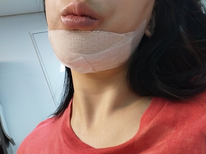 after photo: 턱끝보형물제거