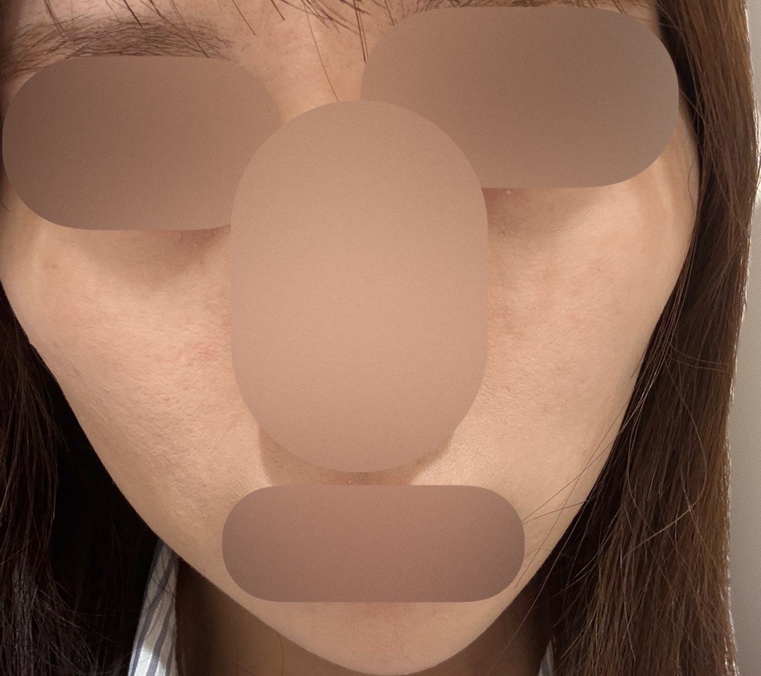 エレクトロポレーション＋選べる薬剤（ビタミンor ボトックス or