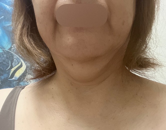 before photo: 脂肪溶解注射(顔)