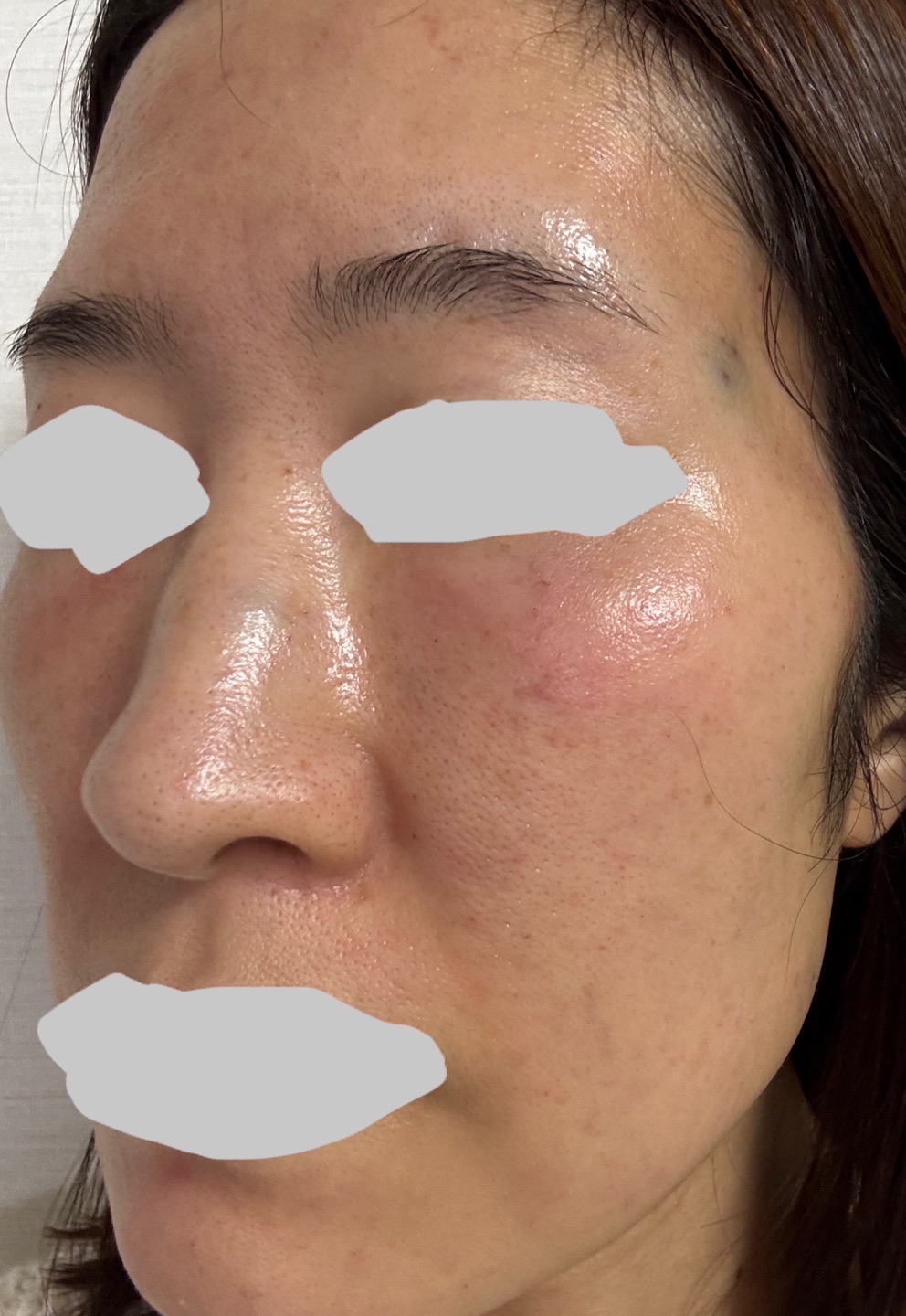 【新品】　サイトケア532 美容液　2本 水光注射サイトケア532（全顔） 1回【再来OK】 | ライズワン美容皮膚科