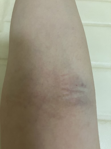 before photo: ビタミン注射・点滴