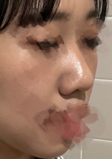 before photo: 콧대(자가조직), 코끝(자가연골)