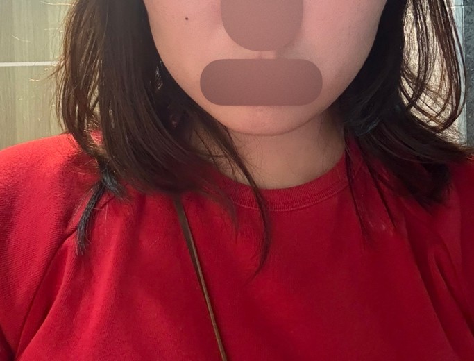 before photo: 윤곽주사, 얼굴지방분해주사