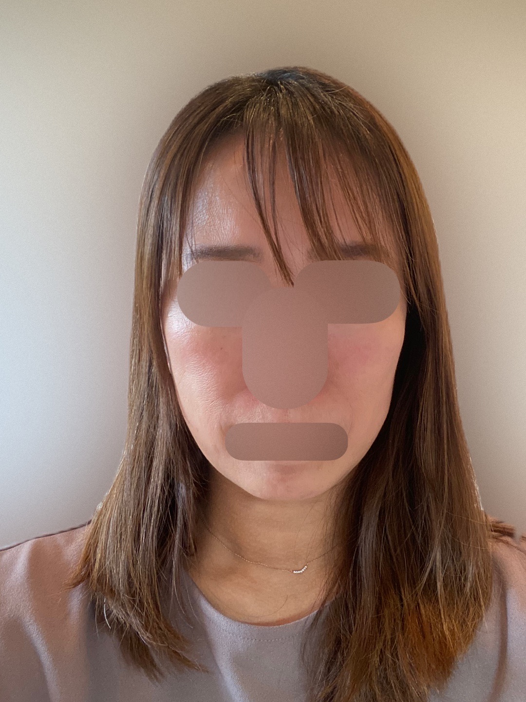 HIFU全顔650shot ウルトラフォーマーMPT【2月28日迄にご予約頂いた方